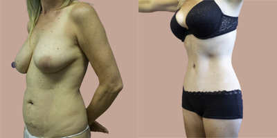Case 2872 - 45-54 year old woman treated with Tummy Tuck