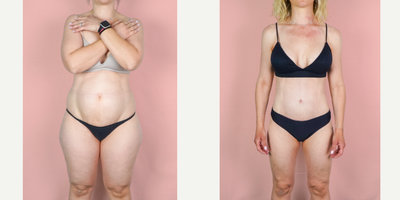 Case 288 - 35-44 year old woman treated with Mommy Makeover, Tummy Tuck, Breast Augmentation, Liposuction, Breast Implants