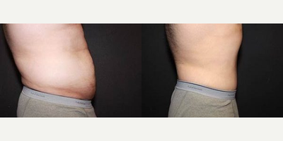 Case 2893 - Man treated with Tummy Tuck