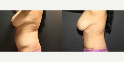 Case 2894 - Woman treated with Tummy Tuck