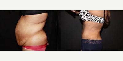 Case 2895 - Woman treated with Tummy Tuck