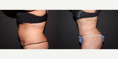 Case 2896 - Woman treated with Tummy Tuck