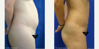 Case 2897 - 25-34 year old woman treated with Tummy Tuck