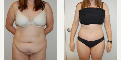 Case 29 - Woman treated with Tummy Tuck