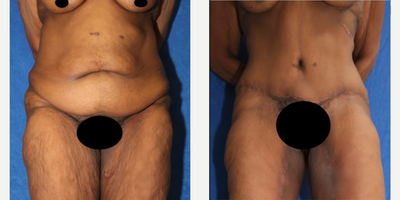 Case 291 - 55-64 year old woman treated with Tummy Tuck