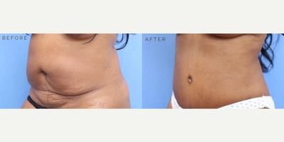 Case 2911 - Woman treated with Tummy Tuck