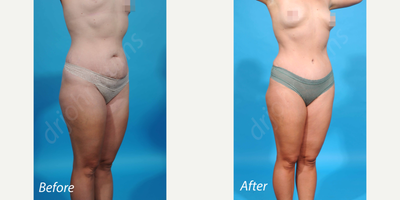 Case 2913 - 35-44 year old woman treated with Tummy Tuck