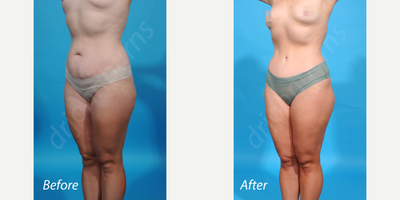 Case 2914 - 35-44 year old woman treated with Tummy Tuck