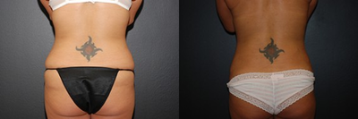 Case 2916 - Woman treated with Tummy Tuck