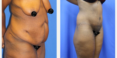Case 2917 - 25-34 year old woman treated with Tummy Tuck