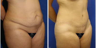 Case 2918 - 35-44 year old woman treated with Tummy Tuck