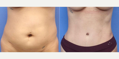 Case 292 - Woman treated with Tummy Tuck, Liposuction