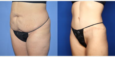 Case 2930 - 25-34 year old woman treated with Tummy Tuck