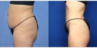 Case 2931 - 25-34 year old woman treated with Tummy Tuck