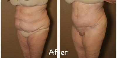 Case 2932 - Woman treated with Tummy Tuck