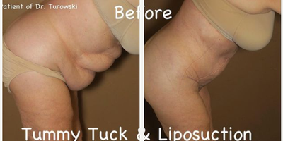 Case 2933 - Woman treated with Tummy Tuck