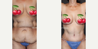 Case 295 - Woman treated with Tummy Tuck, Breast Augmentation, Breast Lift