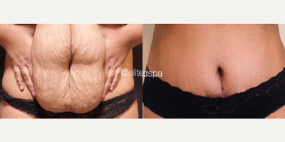 Case 296 - Woman treated with Tummy Tuck