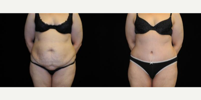 Case 297 - Woman treated with Tummy Tuck