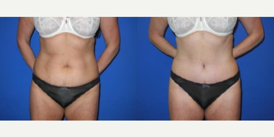 Case 298 - 35-44 year old woman treated with Tummy Tuck