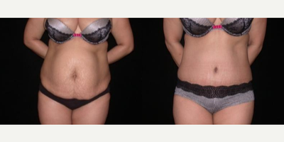 Case 299 - Woman treated with Tummy Tuck