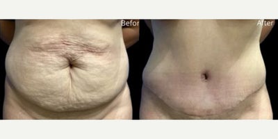 Case: 3 - before and after photo of Woman treated with Tummy Tuck by Stephen T. Greenberg, MD, FACS