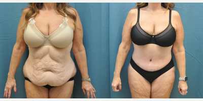 Case 30 - Woman treated with Tummy Tuck