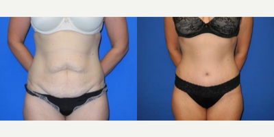 Case 300 - Woman treated with Tummy Tuck