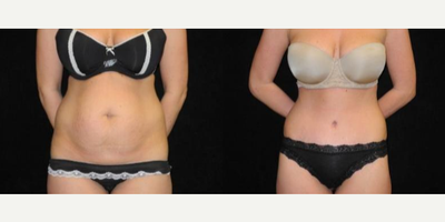 Case 301 - Woman treated with Tummy Tuck