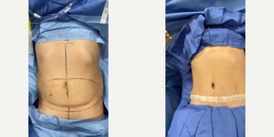 Case 302 - 55-64 year old woman treated with Tummy Tuck