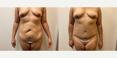 Case 303 - Woman treated with Tummy Tuck