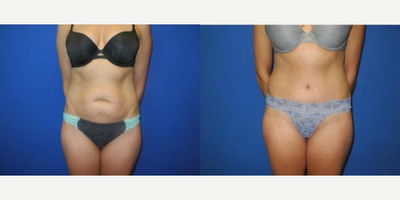 Case 304 - Woman treated with Tummy Tuck