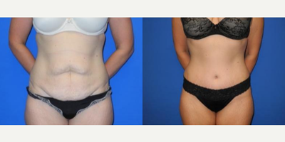 Case 305 - Woman treated with Tummy Tuck