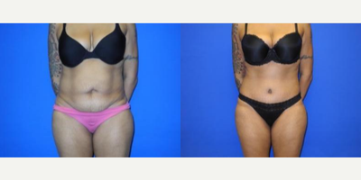 Case 306 - Woman treated with Tummy Tuck