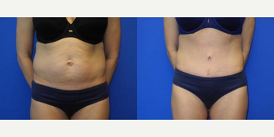 Case 307 - Woman treated with Tummy Tuck