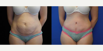 Case 308 - Woman treated with Tummy Tuck