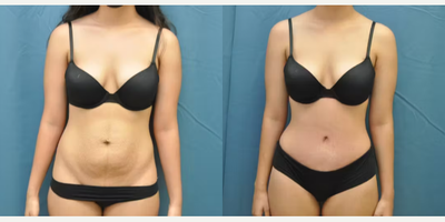 Case 31 - Woman treated with Tummy Tuck