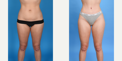 Case 314 - 25 year old woman treated with Tummy Tuck