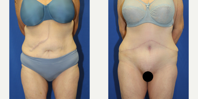 Case 316 - 55-64 year old woman treated with Tummy Tuck