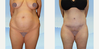 Case 317 - 35-44 year old woman treated with Tummy Tuck
