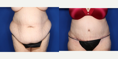 Case 319 - 55-64 year old woman treated with Tummy Tuck