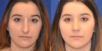 Case: 3195 - before and after photo of Woman treated with Rhinoplasty by Ali Sajjadian, MD, FACS