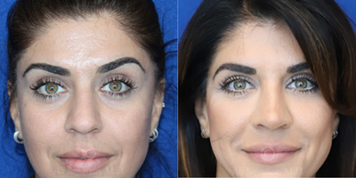 Case: 3196 - before and after photo of Woman treated with Rhinoplasty by Ali Sajjadian, MD, FACS