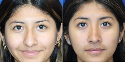 Case: 3197 - before and after photo of Woman treated with Rhinoplasty by Ali Sajjadian, MD, FACS