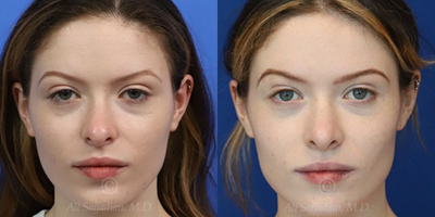 Case: 3198 - before and after photo of Woman treated with Rhinoplasty by Ali Sajjadian, MD, FACS
