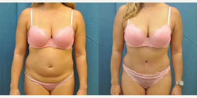 Case 32 - Woman treated with Tummy Tuck