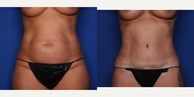 Case 320 - 45-54 year old woman treated with Tummy Tuck