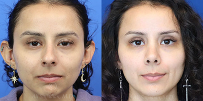 Case: 3205 - before and after photo of Woman treated with Rhinoplasty by Ali Sajjadian, MD, FACS
