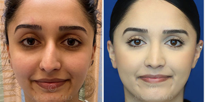 Case: 3206 - before and after photo of Woman treated with Rhinoplasty by Ali Sajjadian, MD, FACS