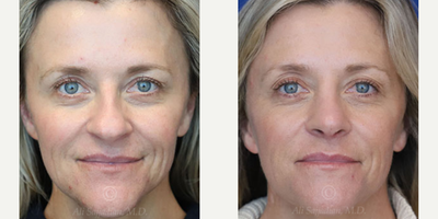 Case: 3207 - before and after photo of Woman treated with Rhinoplasty by Ali Sajjadian, MD, FACS